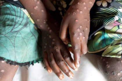 mpox is not under control in africa warns africa cdc अफ्रीका में एमपॉक्स नियंत्रण में नहीं है, अफ्रीका सीडीसी, ईटी हेल्थवर्ल्ड ने चेतावनी दी